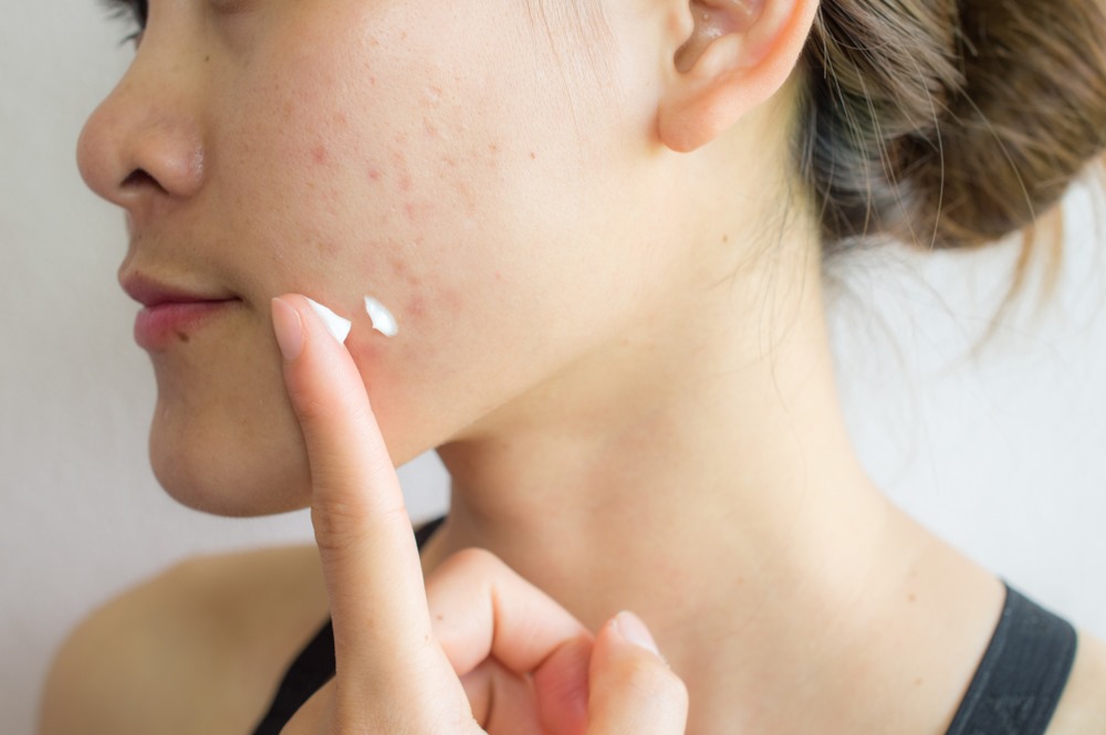 Acne & Use of Salicylic acid